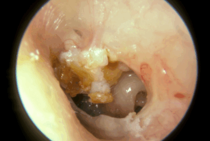 L&rsquo;otite moyenne chronique cholestéatomateuse: C&rsquo;est quoi au juste?