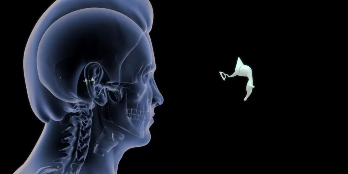 L’otospongiose : quand un tout petit os de l’oreille freine l’audition